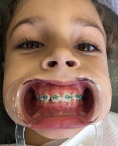 Braces for Children Orthodontic Treatment for Children: Removable Braces and OverlaysBaby Braces. 31/07/2024 orthodontic treatment of children