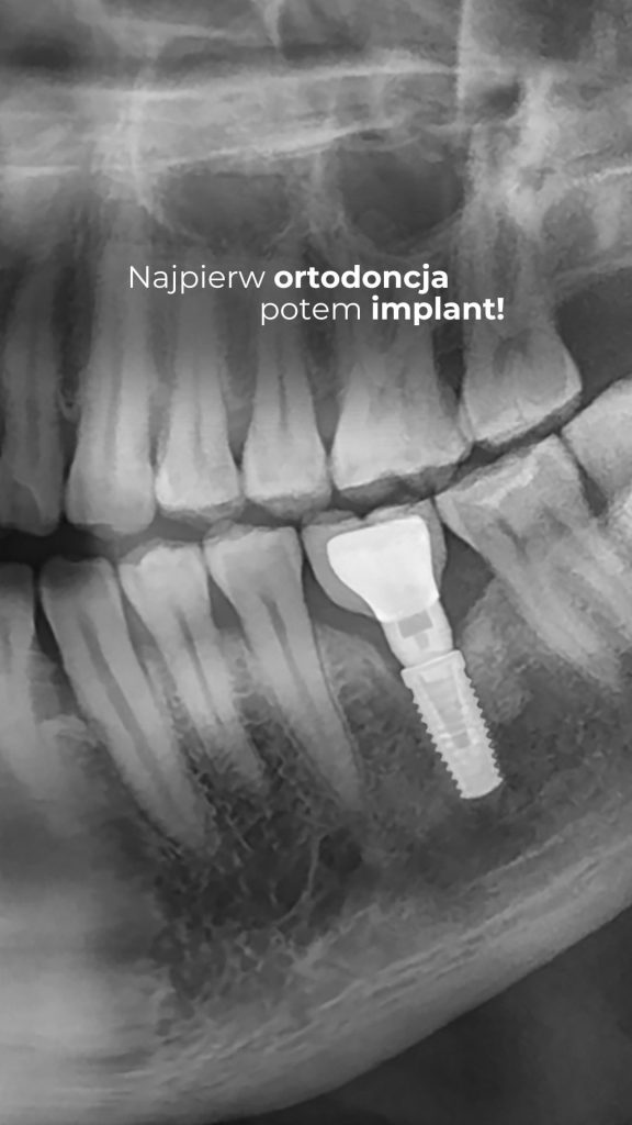Implantacja zębów - jak wygląda zabieg? 08/10/2021 Implantacja zębów - czy wszczepienie implantu boli?