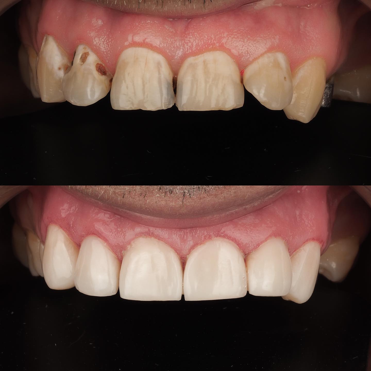 Full Ceramic Veneer – Classic 12/07/2022 full ceramic veneer