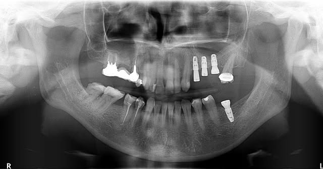 Intraoperative Spot X-ray 12/07/2022 intraoperative spot x-ray