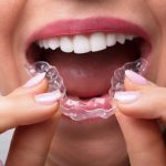Do teeth straightening aligners work? 21/09/2022 Stomo Clinic Wrocław Dentysta Ortodonta Implanty straightening aligners 1