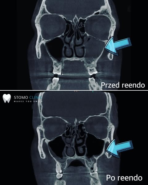 Repeat root canal treatment (reendo) 27/01/2025 reendo - stomo Clinic Wroclaw