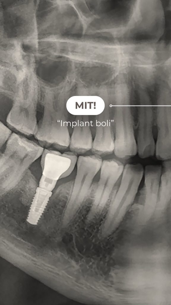 Implants 13/11/2020 dental implant wrocław