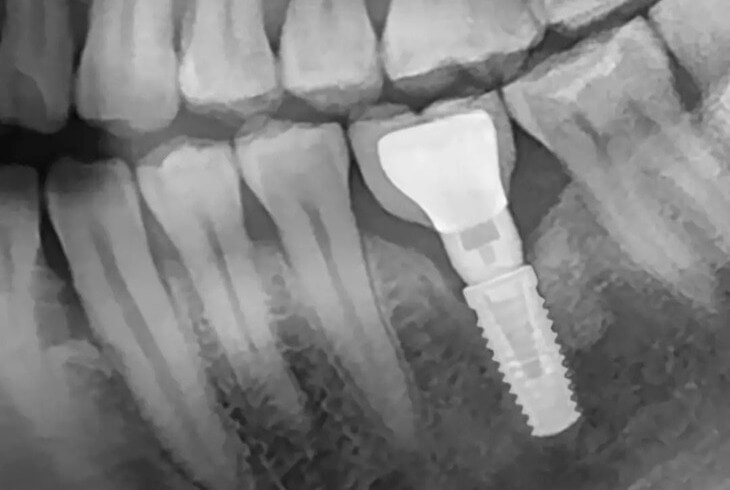 czy implant zęba boli