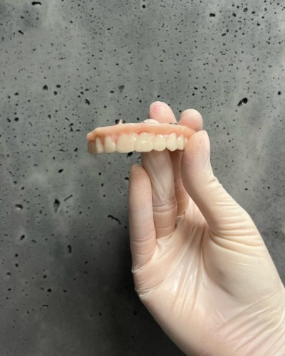 Implant-supported dentures Wroclaw 13/11/2020 upper implant-supported dentures held by an implantologist
