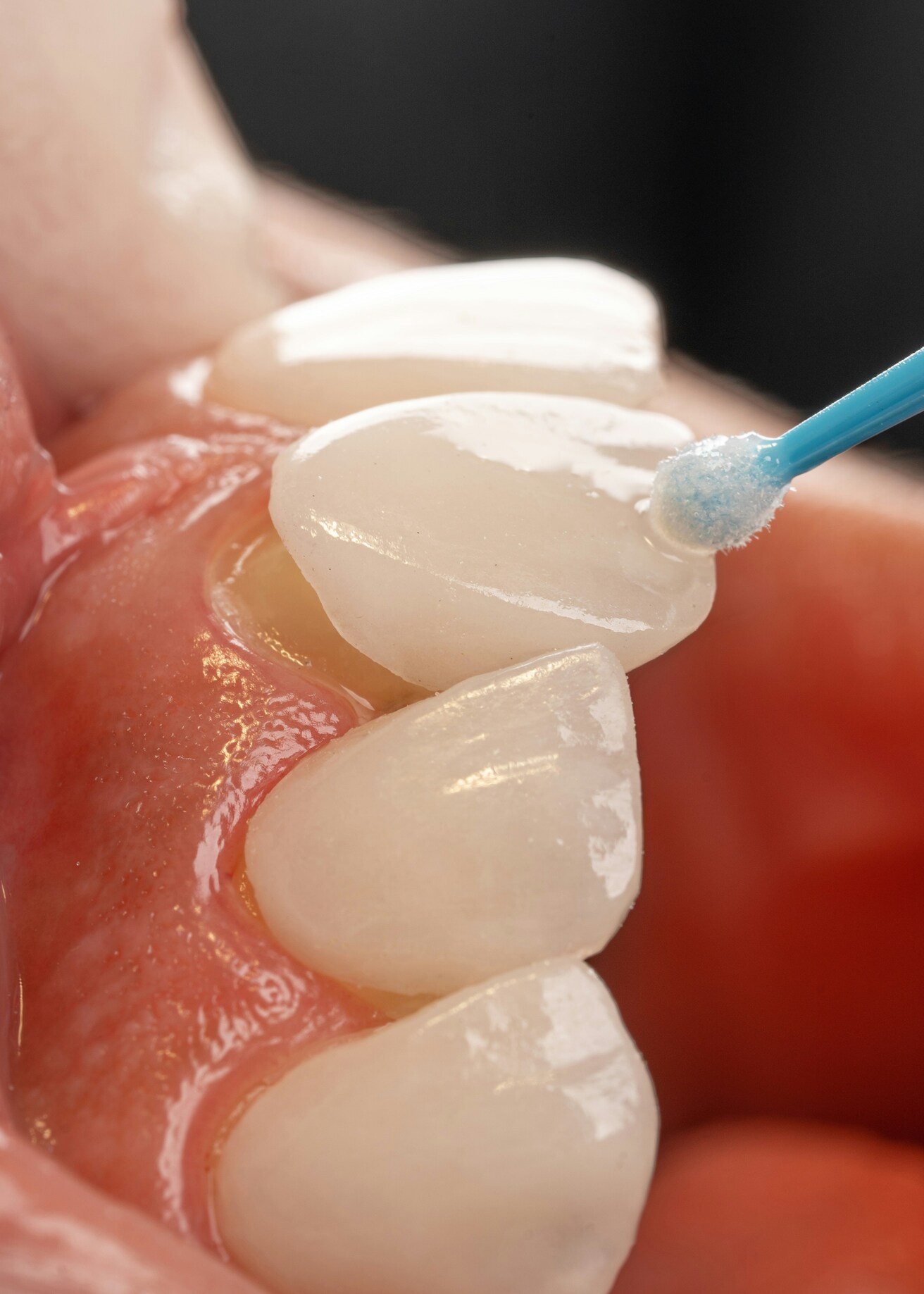 Prosthetics / Smile Aesthetics 01/02/2025 korona porcelanowa protetyka uśmiechu