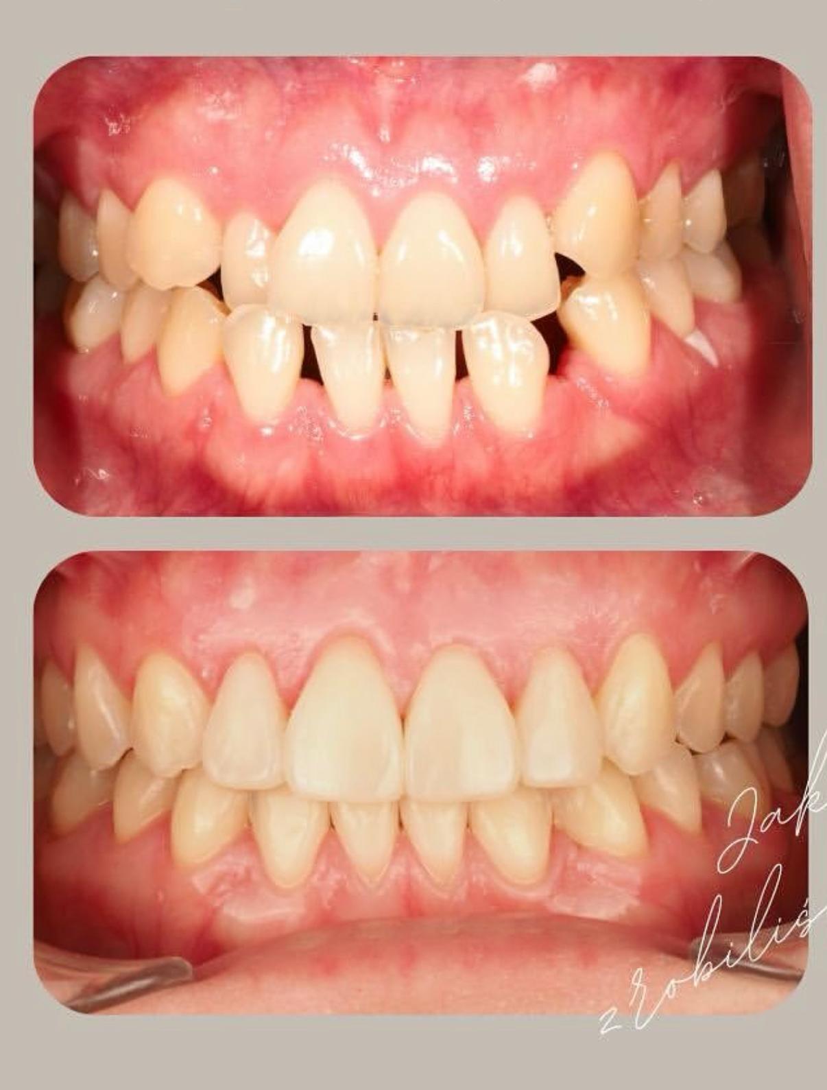 Orthodontist - Wroclaw 20/01/2021 braces before and after
