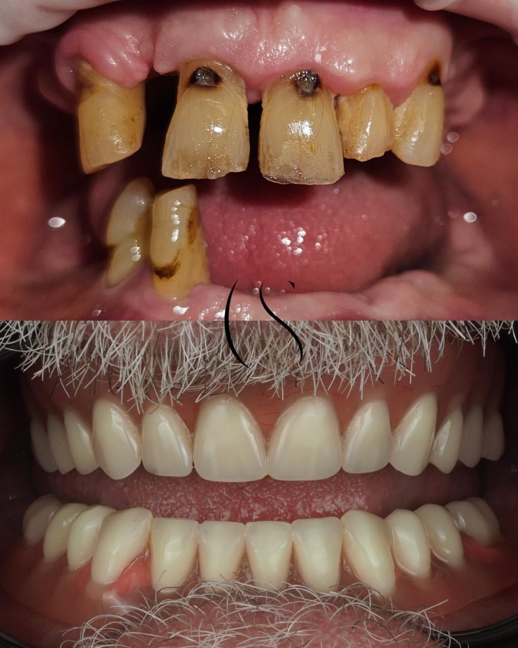 PROSTHESIS ON 6 IMPLANTS - Fixed Restoration (Zirconia Bridge) 25/11/2025 prosthesis on 6 implants