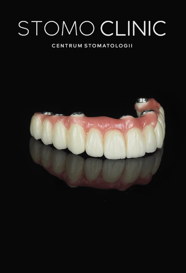DENTURE ON 6 IMPLANTS - Removable Denture 25/11/2025 DENTURE ON 6 IMPLANTS - Removable Denture