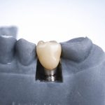 How much does a tooth implant cost and what affects the price? 08/01/2026 how much does a tooth implant cost in Wroclaw