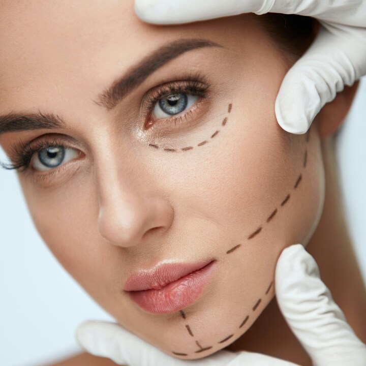 Secondary Upper Eyelid Surgery 05/02/2026 facial surgery wrocław