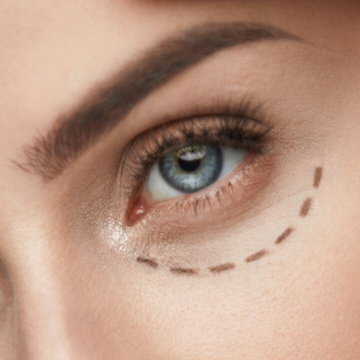 Lower eyelid plasty 05/02/2026 eyelid plastics wroclaw blepharoplasty