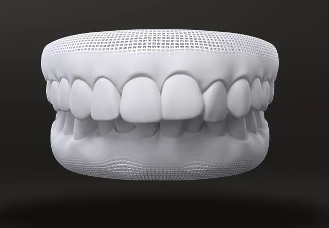 What malocclusion is treated by Invisalign 11/04/2026 Vertical overbite