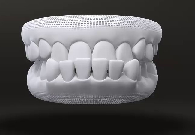 What malocclusion is treated by Invisalign 11/04/2026 Forebite
