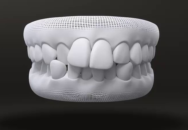 What malocclusion is treated by Invisalign 11/04/2026 Teeth crowding