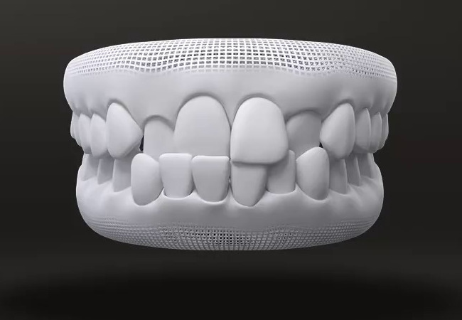 What malocclusion is treated by Invisalign 11/04/2026 Crossbite
