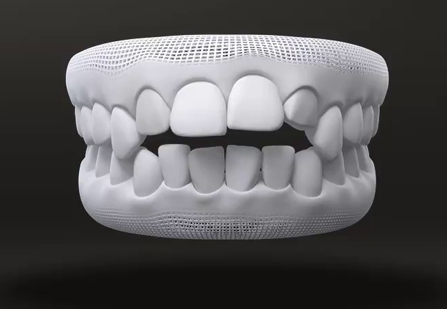 What malocclusion is treated by Invisalign 11/04/2026 Open bite