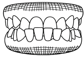 Invisalign Wrocław – przezroczyste nakładki ortodontyczne 04/04/2026 przodozgryz wrocław